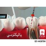 پالپکتومی