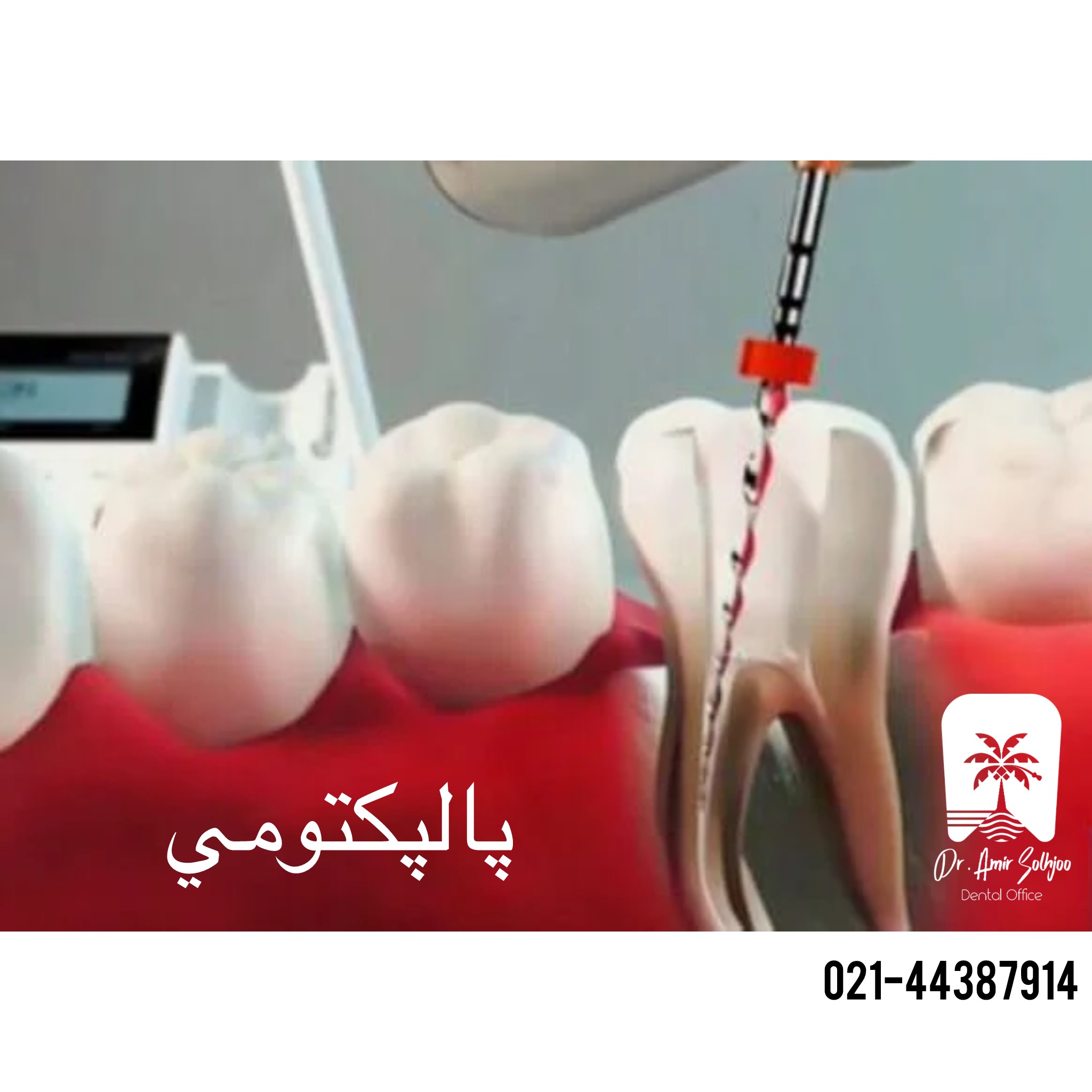 پالپکتومی