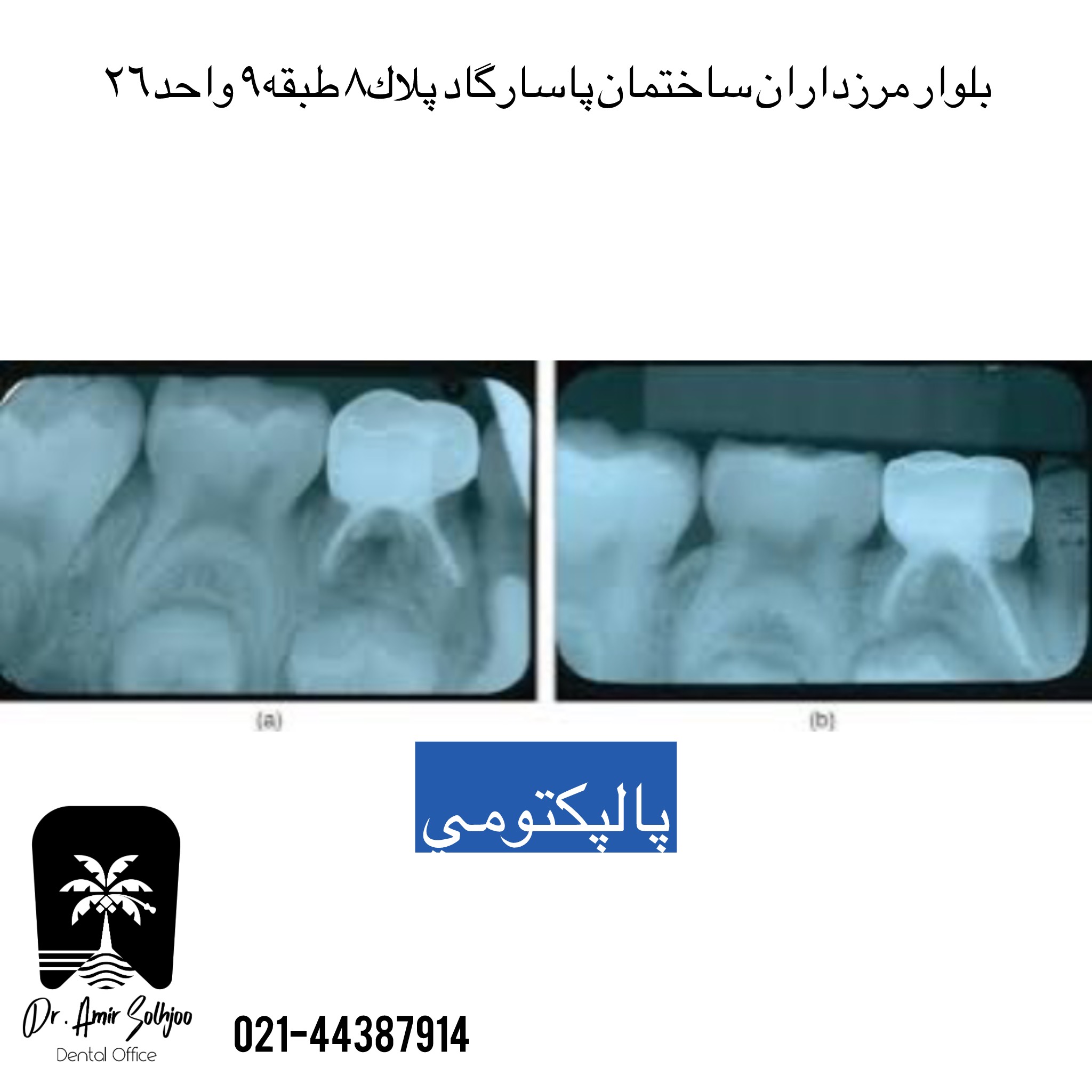 پالپکتومی دندان