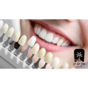 تست رنگ لمینت بر روی دندانها