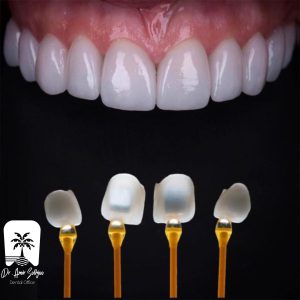 تأثیر رنگ لمینت بر اعتماد به نفس