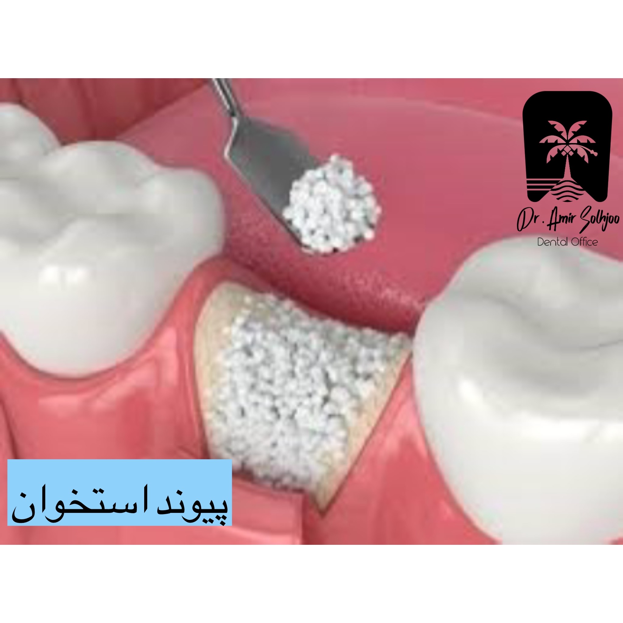 پیوند استخوان: راهی برای تقویت ساختار فک