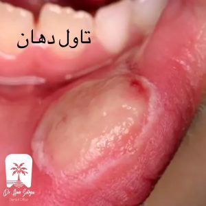 تاول دهان چیست
