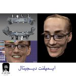 ایمپلنت دیجیتال