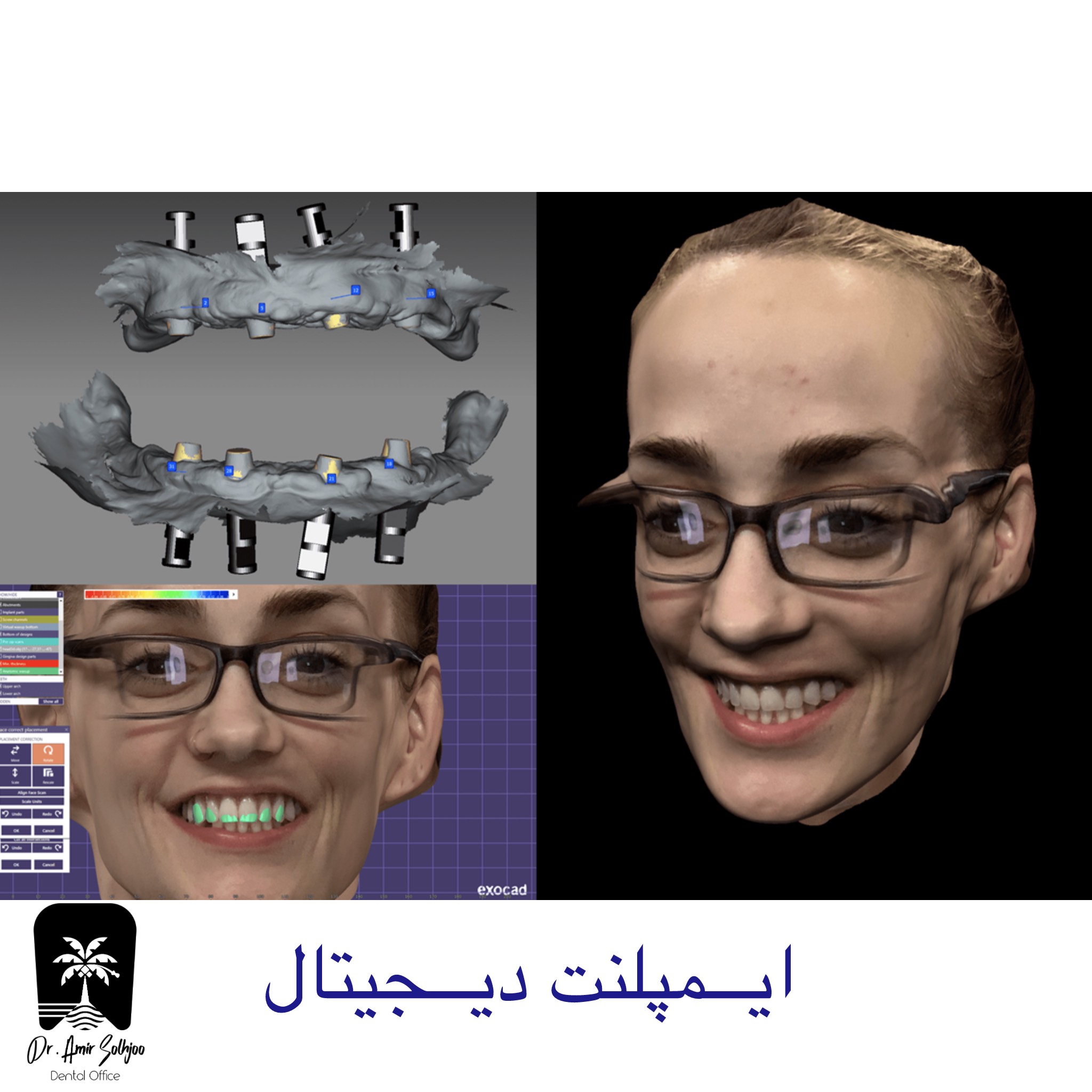 ایمپلنت دیجیتال