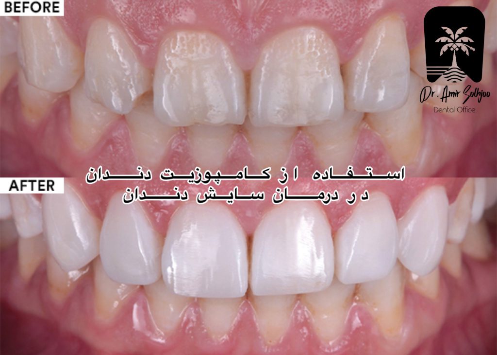 کامپوزیت دندان