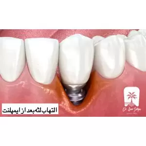 التهاب لثه