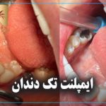 ایمپلنت تک دندان
