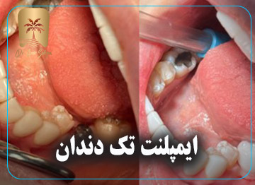 ایمپلنت تک دندان