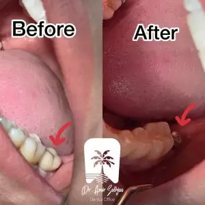 عکس قبل و بعد کاشت ایمپلنت