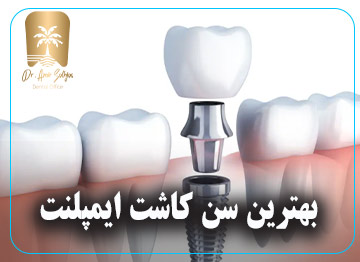 بهترین سن کاشت ایمپلنت