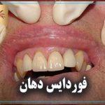 فوردایس دهان