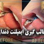 قالب گیری ایمپلنت دندان