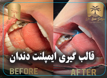قالب گیری ایمپلنت دندان