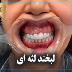 لبخند لثه ای