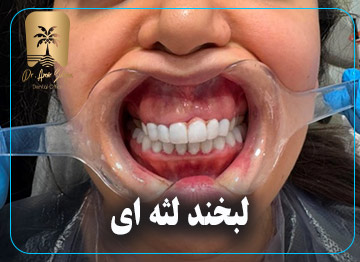 لبخند لثه ای