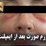 ورم صورت بعد از ایمپلنت