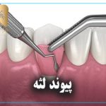 پیوند لثه