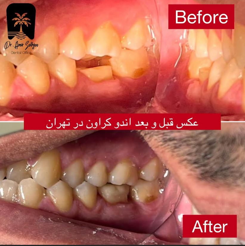 اندو کراون