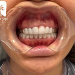 اصلاح لبخند لثه ای