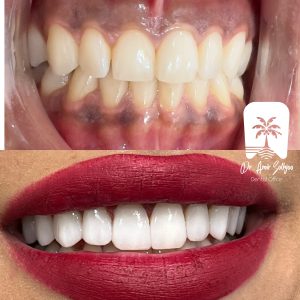 عکس نمونه کار کامپوزیت دندان