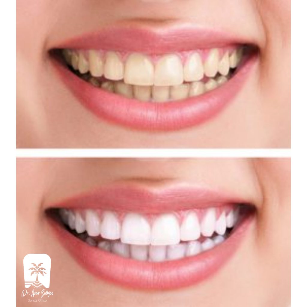 افزایش طول عمر دندان
