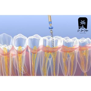 Nervation and prevention of complications