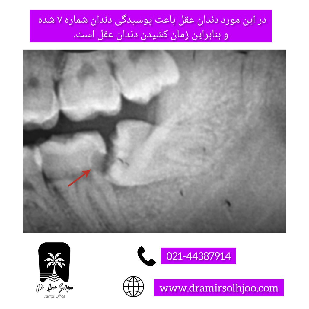 بهترین کلینیک کشیدن دندان عقل در تهران