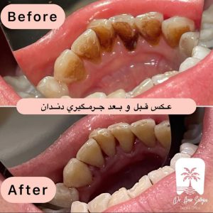 تاثیر فواید جرمگیری دندان