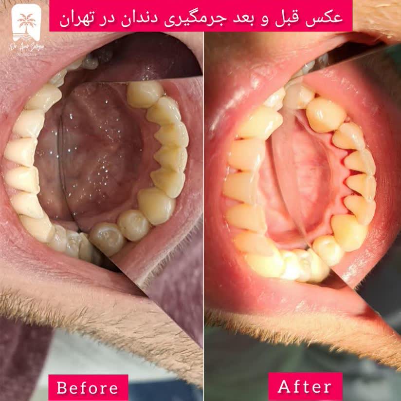 عکس قبل و بعد جرمگیری دندان در تهران