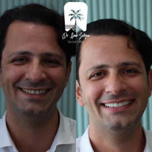 تصویر قبل و بعد کامپوزیت دندان