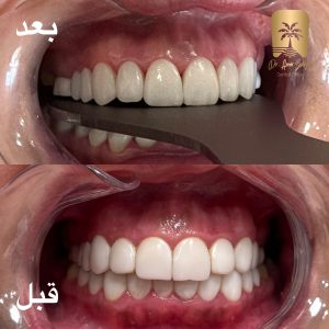 تعویض کامپوزیت بعد از عفونت کامپوزیت