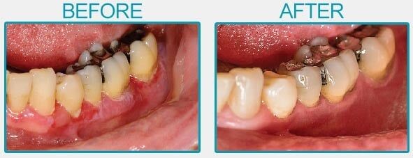 قرص چرک خشک کن قوی
