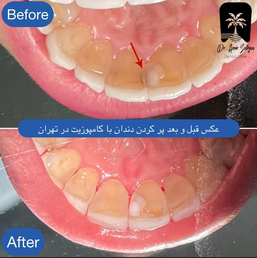 پر کردن دندان با کامپوزیت