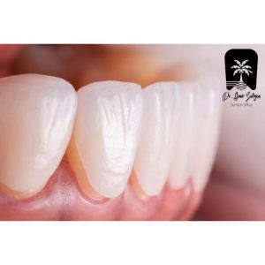 طرح درمان لمینت