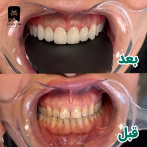 عکس قبل و بعد کامپوزیت سارمکو