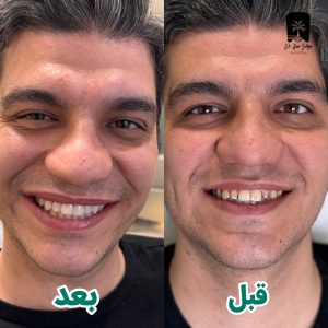 عکس قبل و بعد ترمیم دندان