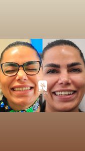 عکس قبل و بعد کامپوزیت طبیعی