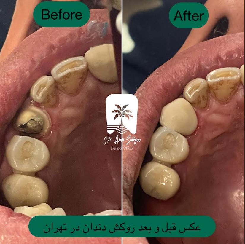روکش دندان