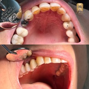 بهترین کلینیک ایمپلنت اورژانسی