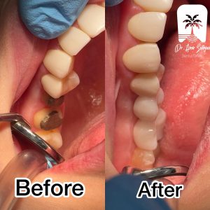 before and after photos of tooth restoration