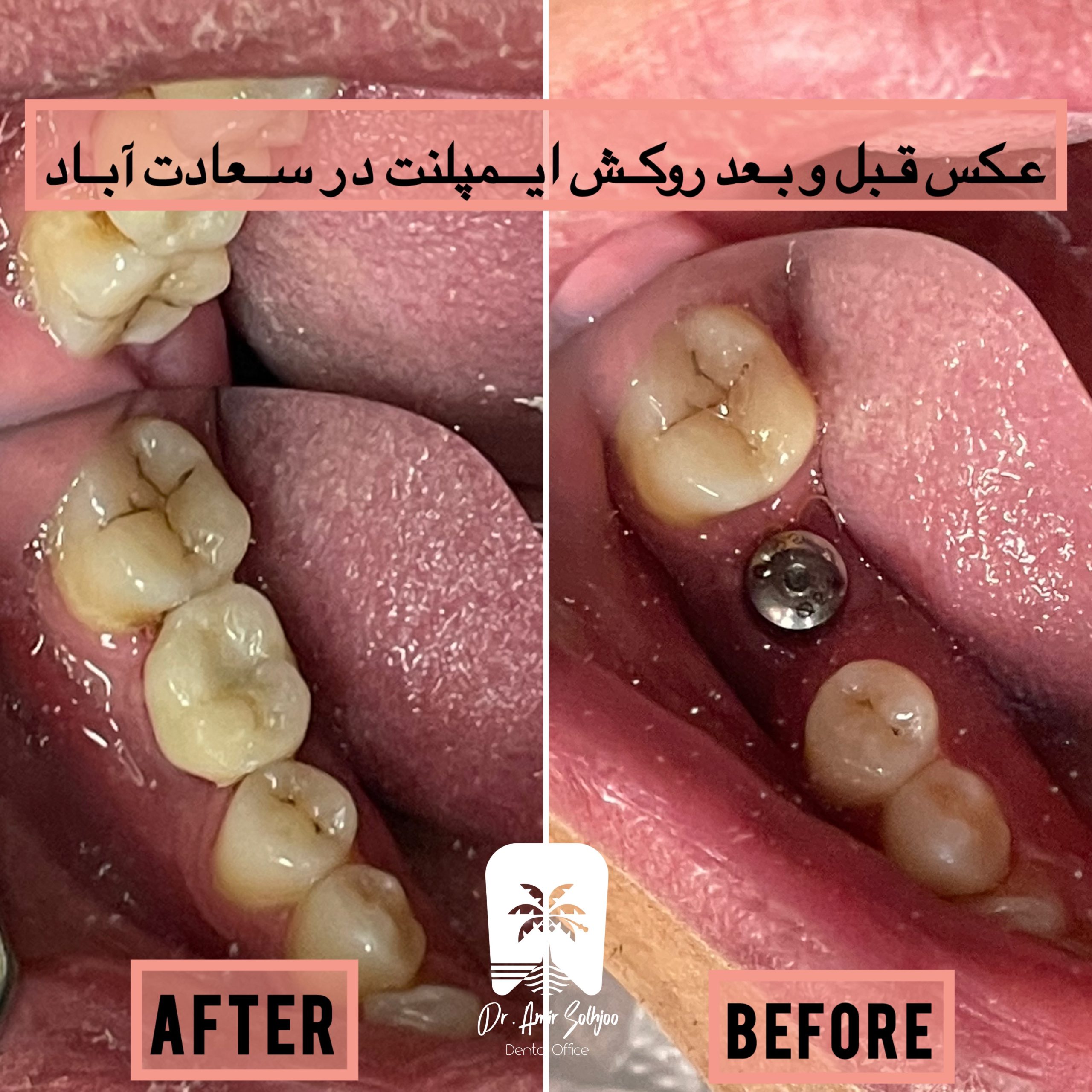 ایمپلنت دندان در مرزداران