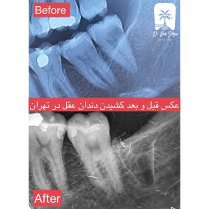 عکس دندان عقل