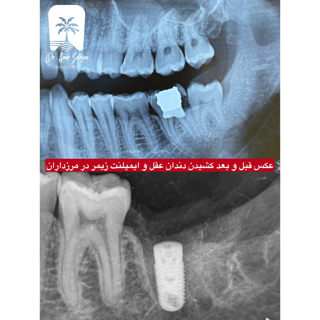 بهترین مرکز ایمپلنت تهران