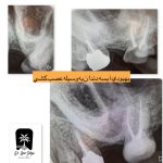 تخلیه آبسه دندان