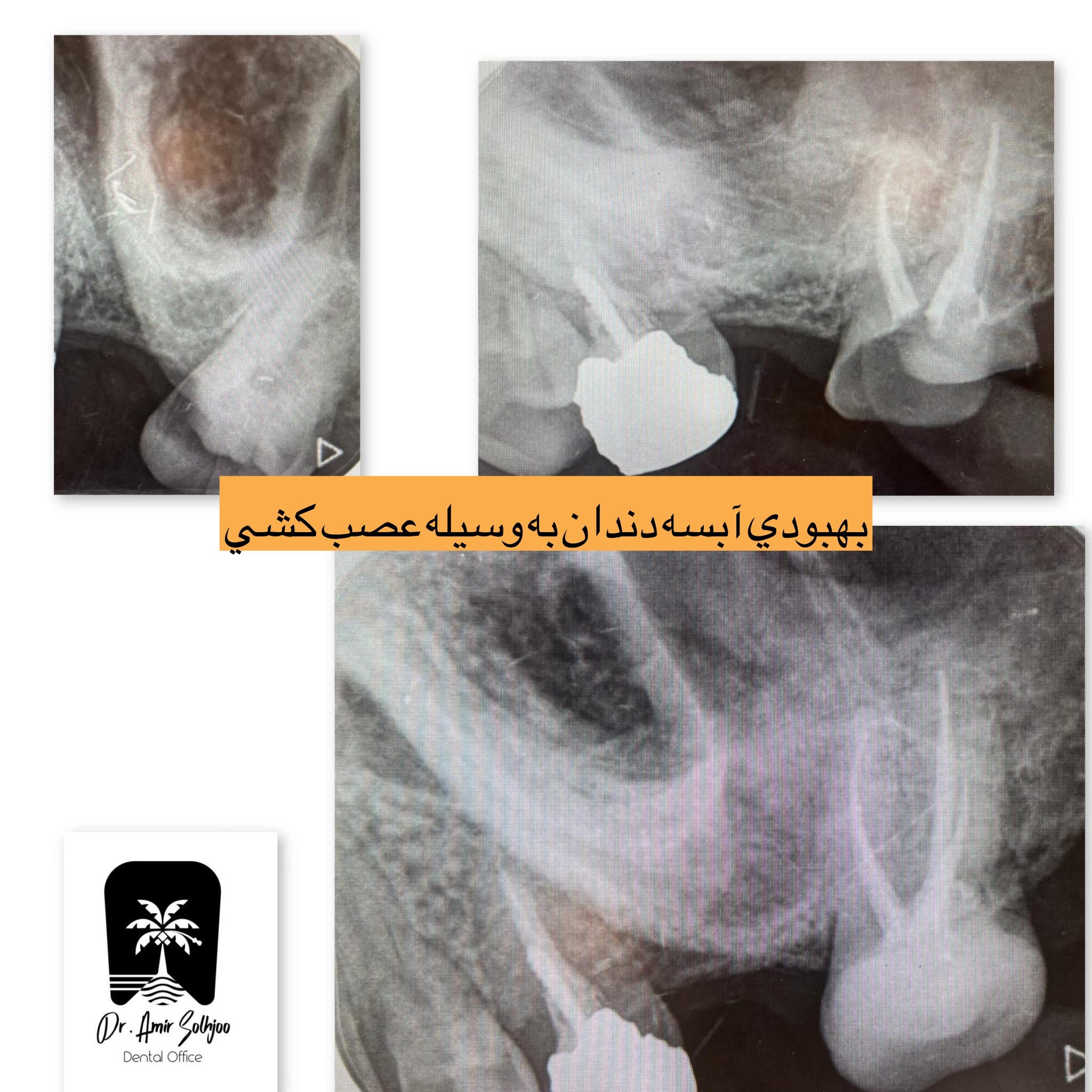 تخلیه آبسه دندان