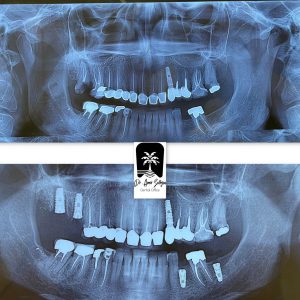 طريقة زرع السجاد الصامت