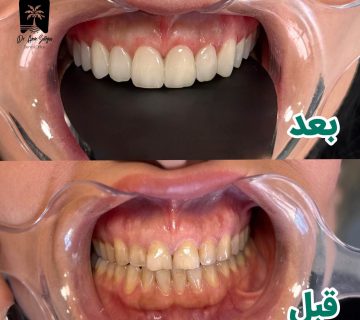 پولیش گامپوزیت دندان