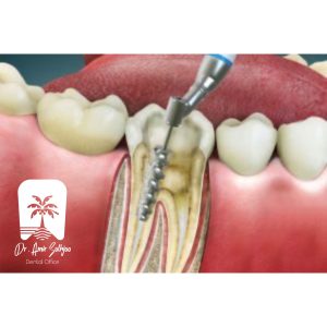 Treatment of headache caused by tooth infection