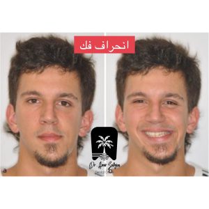 انحراف فک